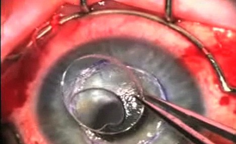 这些病人的治疗效果与接受眼角膜捐赠的效果几乎相同。 这些病人的治疗效果与接受眼角膜捐赠的效果几乎相同。