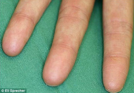 皮纹病患者天生没有指纹 皮纹病患者天生没有指纹