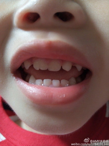 专家问答:儿童牙医朱涛答儿童牙齿保健及护理
