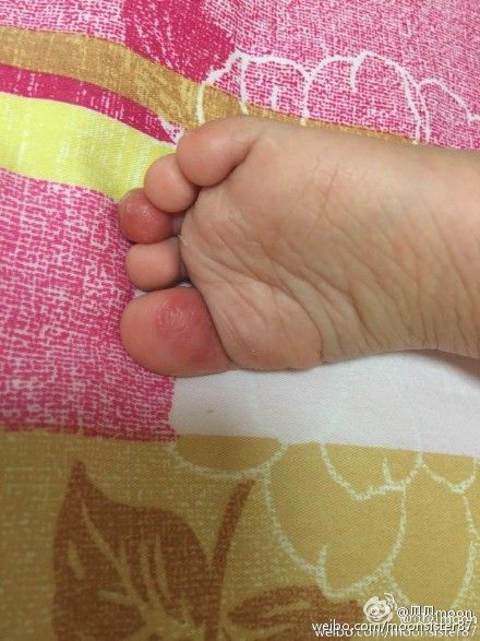 专家问答:育儿专家鲍秀兰答宝宝小状况如何应