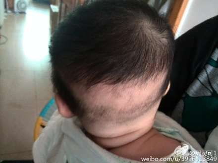 专家问答:张思莱医师答婴幼儿养育及疾病防治