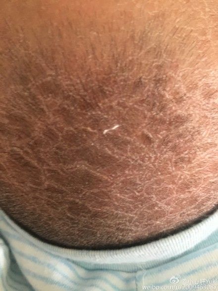 用茶油洗乳痂后变成这样了怎么办?|张思莱|乳痂_新浪育儿_新浪网