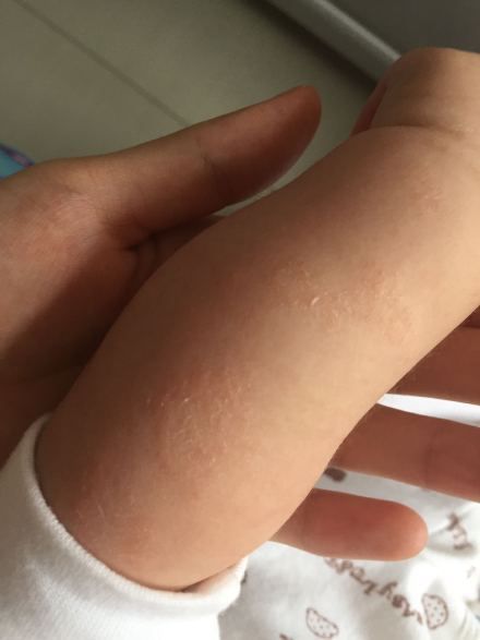 建议用适合过敏宝宝的润肤露护理皮肤,可以短期的用低浓度的氢化