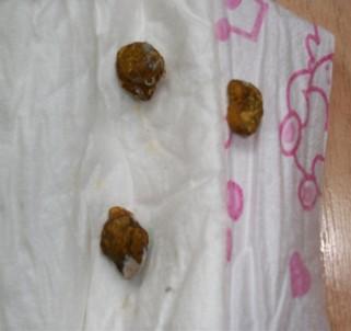 消费者供图:抠出来的小孩大便 消费者供图:抠出来的小孩大便