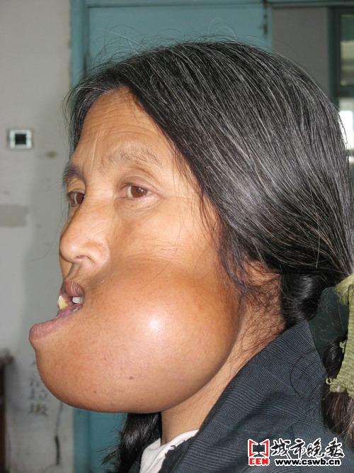 家住伊通县的王树华牙床上长出了一个小包