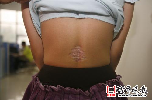 这贴膏药没去痛反留疤(图文)_新闻中心_新浪网