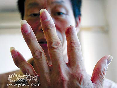 手指断了半截竟不算残疾