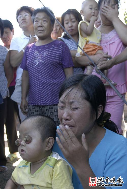 医生说孩子得了嗜酸性肉芽肿