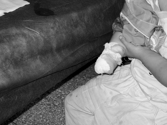 粉碎机咬掉右手小芳今后咋写字