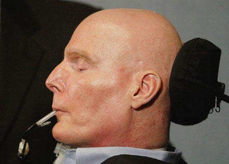 神经干细胞移植:现实还是梦想