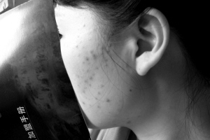 减肥药当排便食品吃 忆念美瘦身瘦出红疹