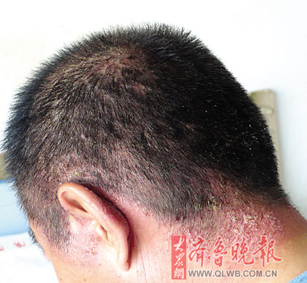 绿色染发剂染出满头红斑