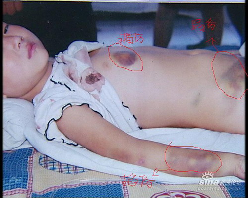 史上最毒后妈 打断幼女脊椎