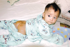 7月女婴 瘤比头大