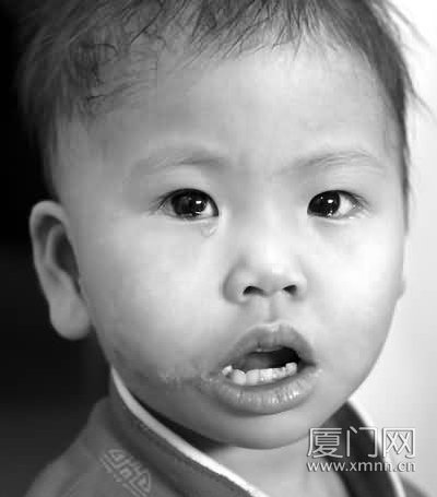 取大腿皮肤,再造外耳道