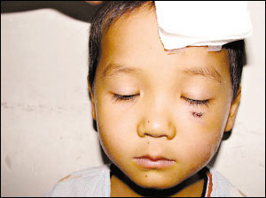 男孩眼肿一年不明原因 竟掏出3条活虫(图)