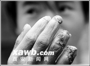手指被打断几近变痴呆(图)