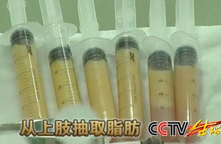 女子吸脂提臀失败 再抽肚皮补凹坑(图)