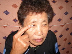 老太眼睛痒+眼睑长小虫