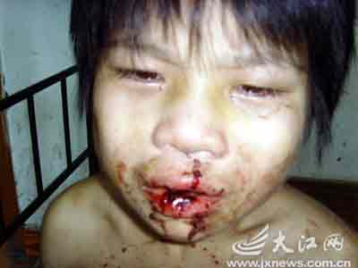 脚肿得变形本报抚州讯记者舒晓燕摄影报道:满脸满身的血迹,嘴巴被打得