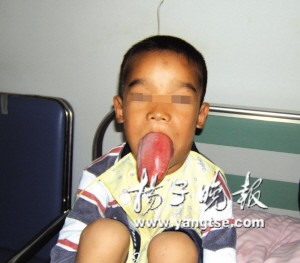 男童患怪病舌头长达12.5厘米(图)