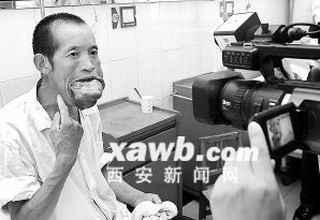 男子患巨舌症30年 舌头肿胀如婴儿头大小(图)