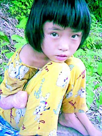 独掌女孩自称被生母烫伤(图)