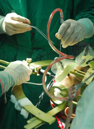 图文:微创手术刀深入脑部工作