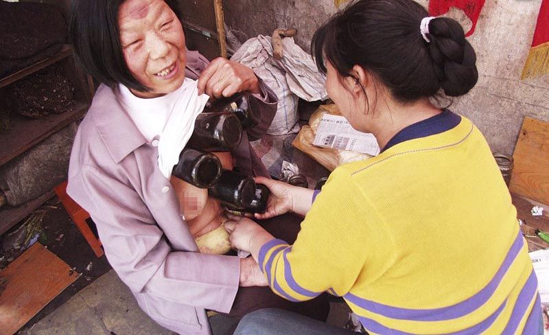 2002年4月,重庆市万州区一位街头医生正帮一位老婆婆进行拔火罐治疗