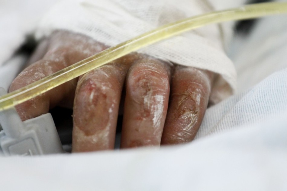 小五生水壶装滚水恶作剧!学弟喝下全身烫伤