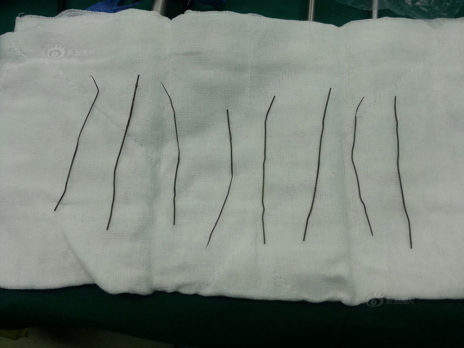 脖子后面有根筋连着脑袋到太阳穴疼怎么回事-