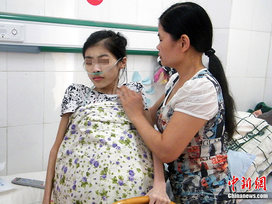 少女患病两年肚子大过孕妇