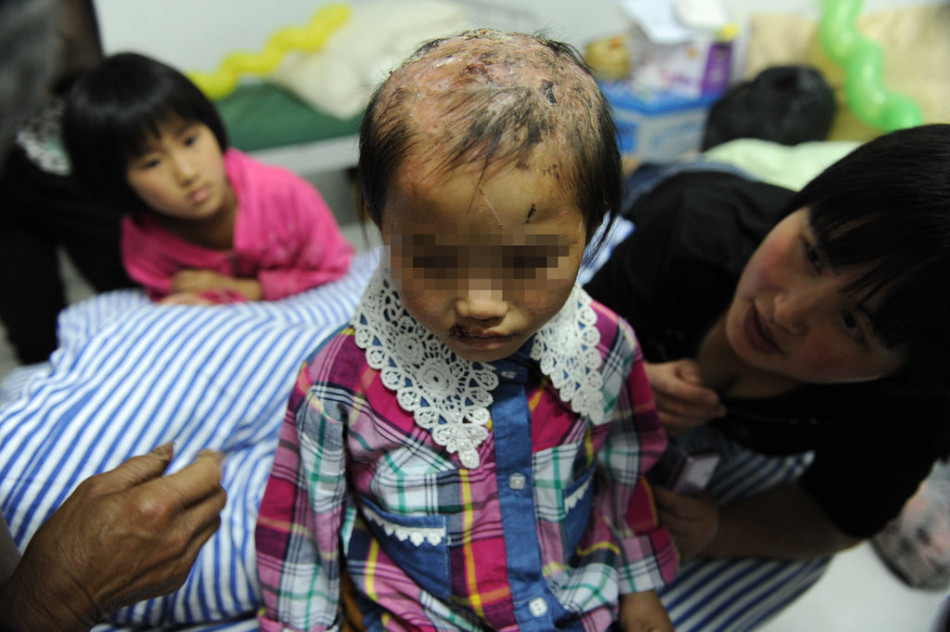 女童遭生父虐待5年开水烫头鱼线缝嘴 高清图集 新浪网