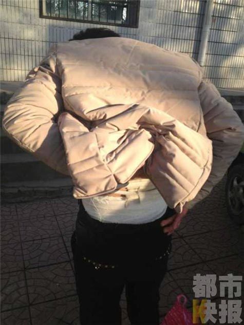 足浴店拔火罐烫伤 经理叫伤者先垫医疗费