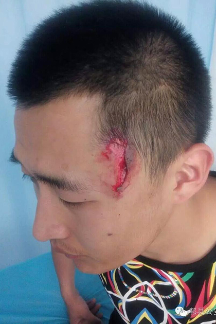 成都辅警被吸毒人员袭击 头部缝合23针