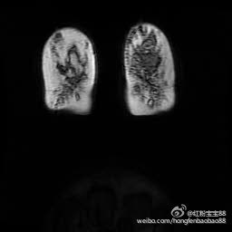 阴道外翻