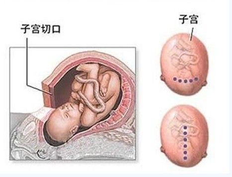 女人剖腹产全过程高清