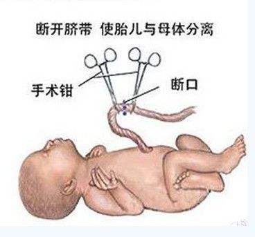 女人剖腹产全过程高清