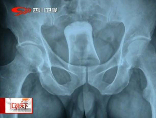肛门人口_人口普查