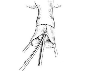 图解包皮手术全过程_怀集长城医院
