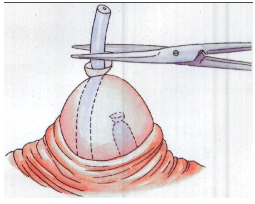 男子结扎手术震撼揭秘_金羊网健康