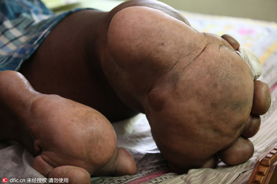 男子患罕见遗传病 巨型双腿如小象 重约200斤(慎)