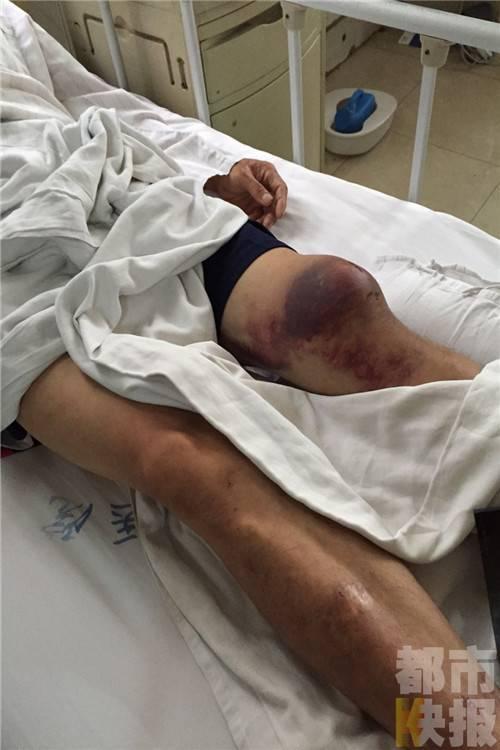男子干活腿骨折 雇佣方欲"买断"医药费
