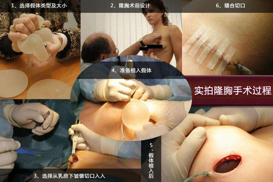 震撼实拍国外美女隆胸手术全过程