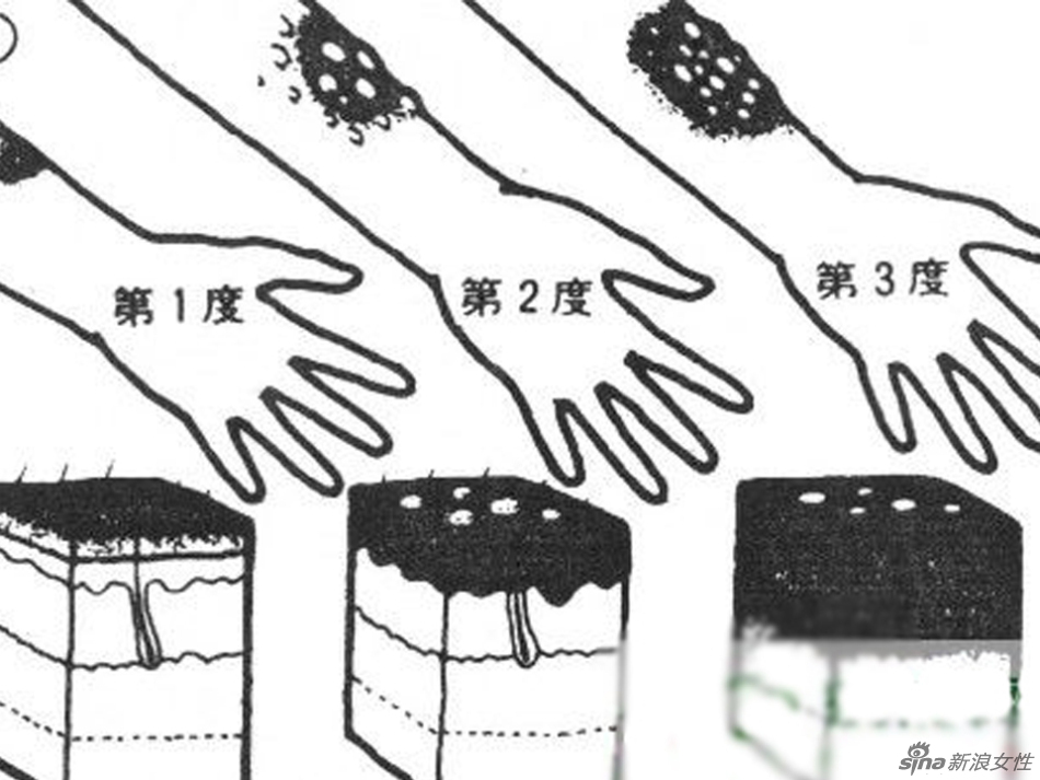 <em>烧伤烫伤</em>的简单处理原则示意图-顺德信息网