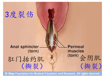 阴道分娩时会阴撕裂伤分级示意图