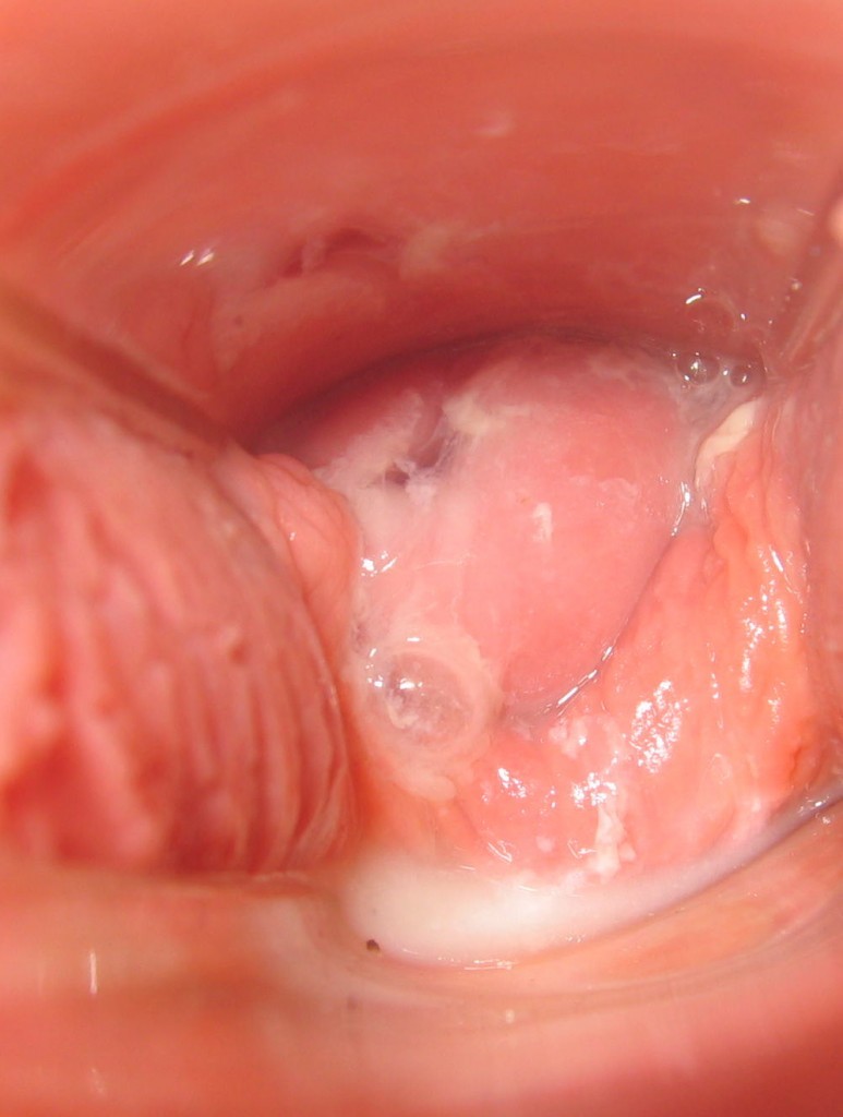 25岁未育女性的完整月经周期里的宫颈变化