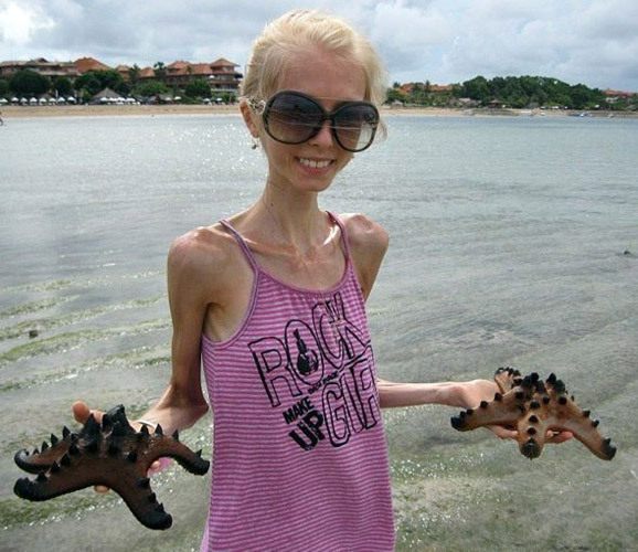 <em>俄罗斯</em>20岁<em>女孩减肥</em>后仅剩20公斤 - 新闻中心