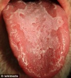 舌头上长出地图：“地图舌”研究取得新进展