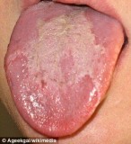 舌头上长出地图：“地图舌”研究取得新进展